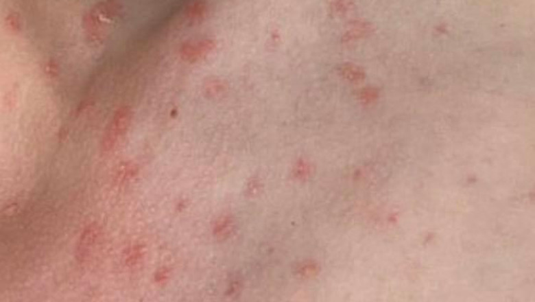 Psoriasis not contagious, must not cause stigma